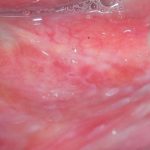 Fig. 4C Caso clinico di lesioni lupus-like caratterizzate da aeree eritematose erosive su mucose geniene, alveolari e gengivali associate a papule e fini reticoli periferici asimmetrici.