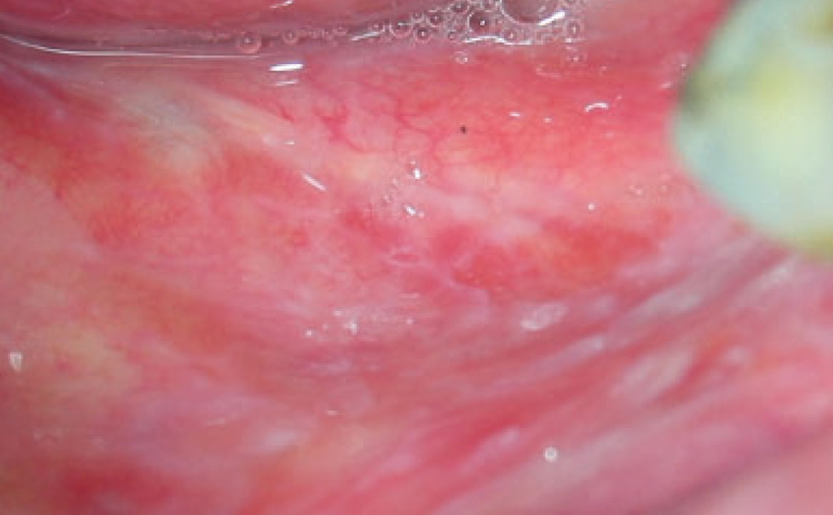 Fig. 4C Caso clinico di lesioni lupus-like caratterizzate da aeree eritematose erosive su mucose geniene, alveolari e gengivali associate a papule e fini reticoli periferici asimmetrici.