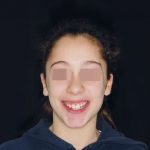 Fig. 13 Fotografia extra orale in fase intermedia di trattamento.