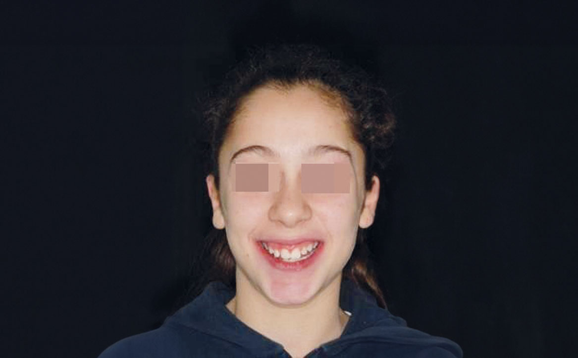 Fig. 13 Fotografia extra orale in fase intermedia di trattamento.