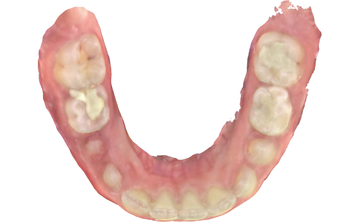 Fig. 7B Modello digitale dell'arcata inferiore.