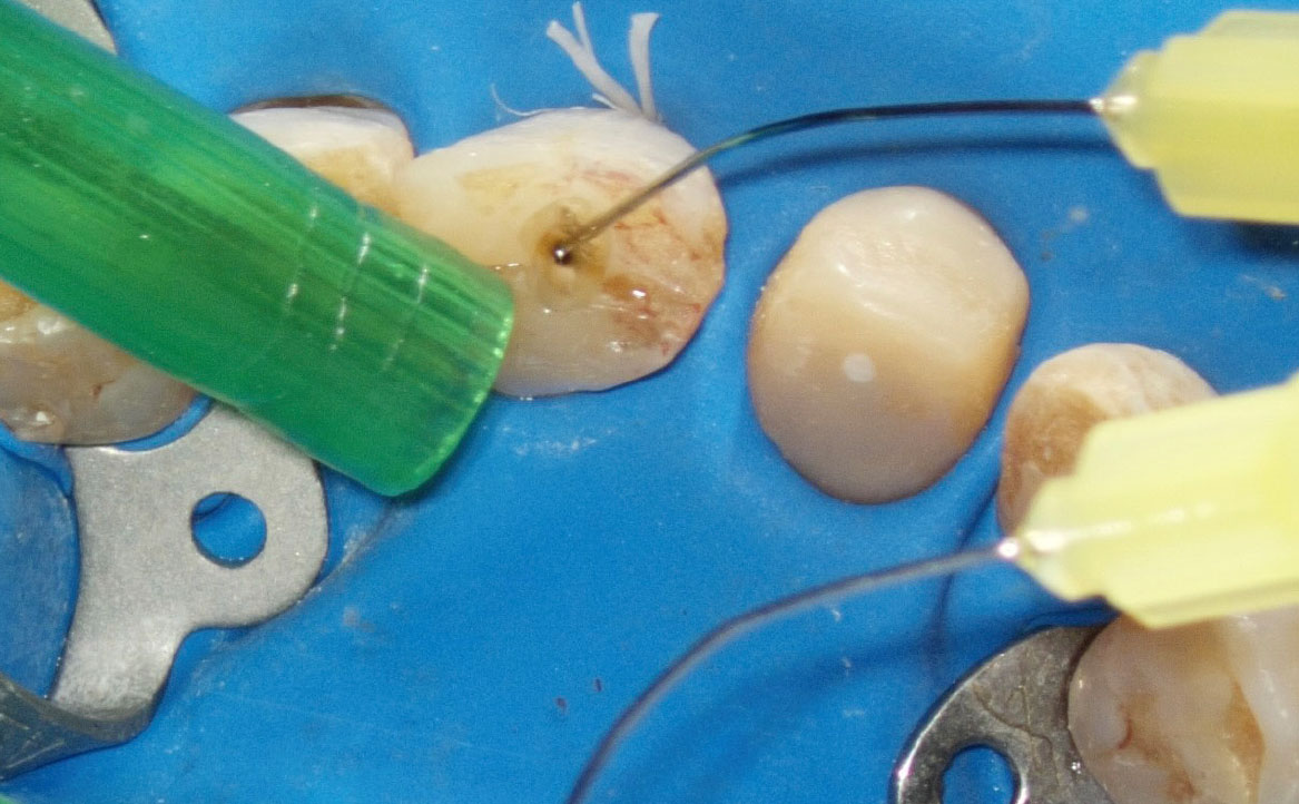 Fig. 8B Terapia canalare di elemento 2.1.: irrigazione.