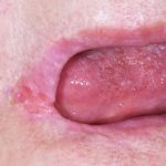 Fig. 3B Manifestazioni cliniche correlate a scialorrea in paziente che assumono clozapina (antipsicotico): cheilite angolare, dermatiti periorali.