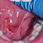 Fig. 5A Caso clinico di pemfigo indotto da farmaci con lesioni erosive diffuse a ventre linguale e palato molle.