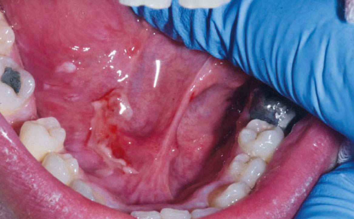Fig. 5A Caso clinico di pemfigo indotto da farmaci con lesioni erosive diffuse a ventre linguale e palato molle.