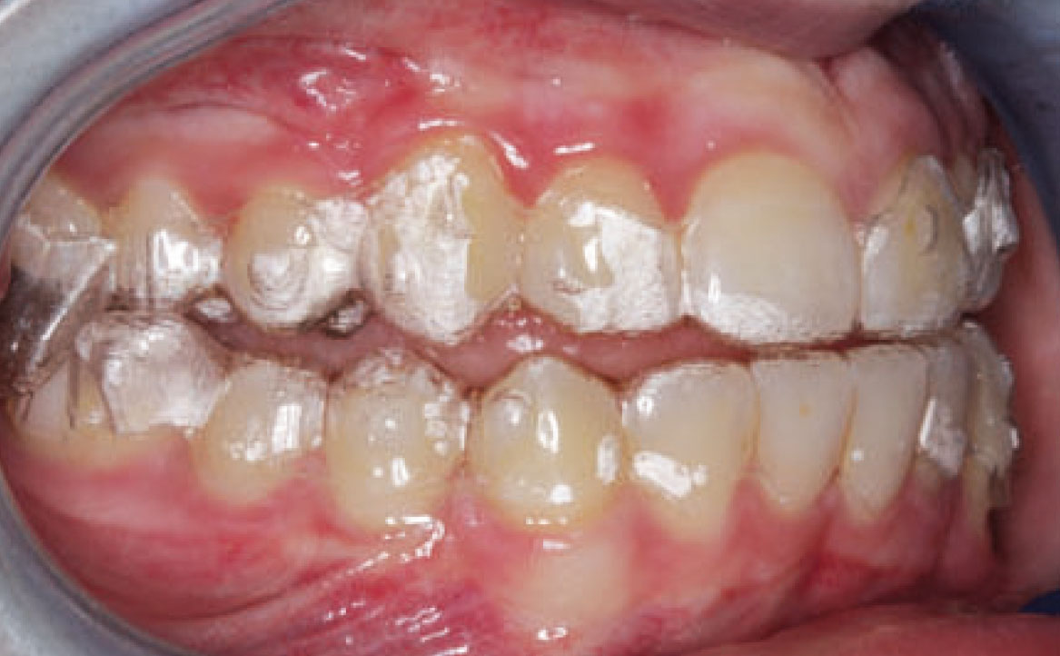 Fig. 7A Foto intraorale laterale di destra, sistema Invisalign® con protocollo MA.