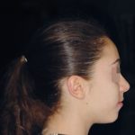 Fig. 14 Fotografia extra orale in fase intermedia di trattamento.