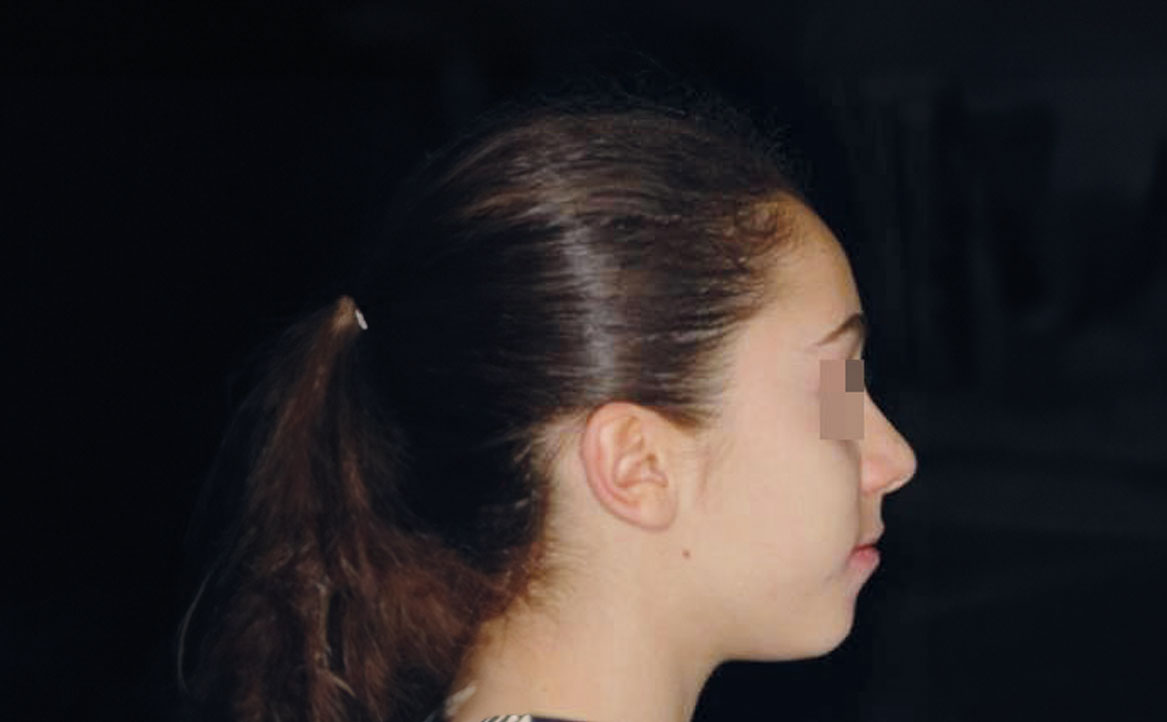 Fig. 14 Fotografia extra orale in fase intermedia di trattamento.