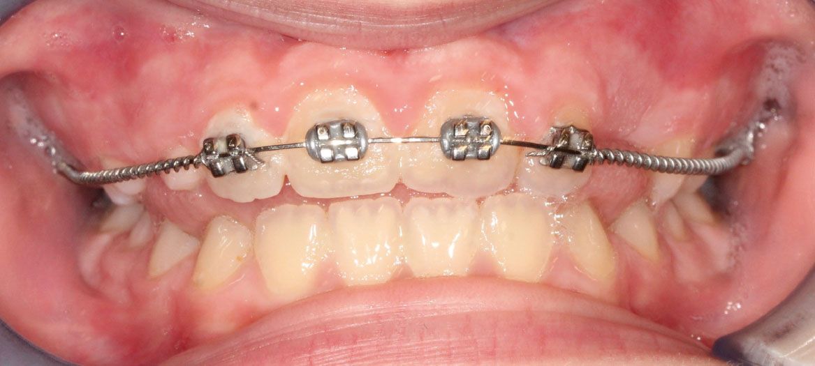 Fig. 8A Terapia intercettiva con REP e bandaggio parziale superiore.