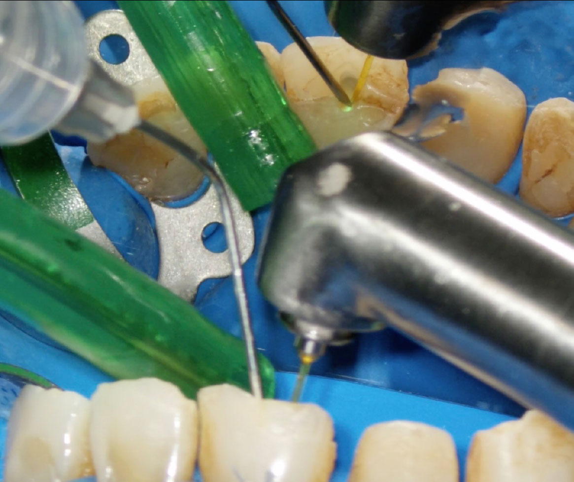 Fig. 8C Terapia canalare di elemento 2.1.: disinfezione del canale con NaOCl 5% attivato da SWEEPS.
