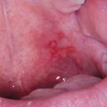 Fig. 5B Caso clinico di pemfigo indotto da farmaci con lesioni erosive diffuse a ventre linguale e palato molle.