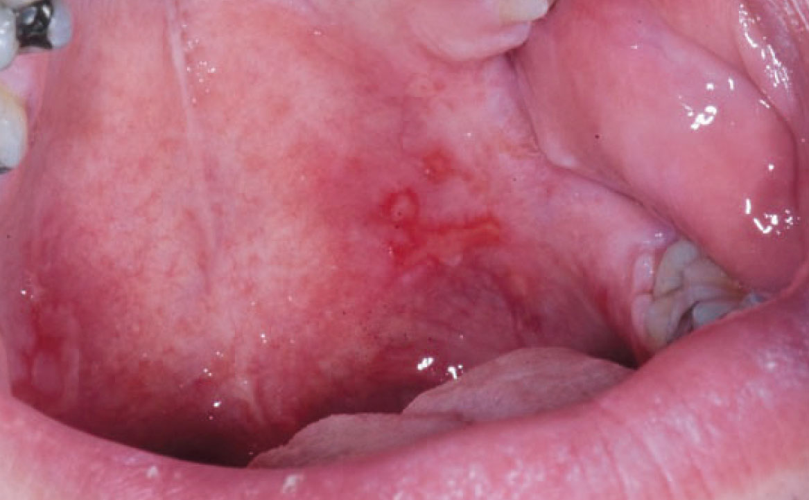 Fig. 5B Caso clinico di pemfigo indotto da farmaci con lesioni erosive diffuse a ventre linguale e palato molle.