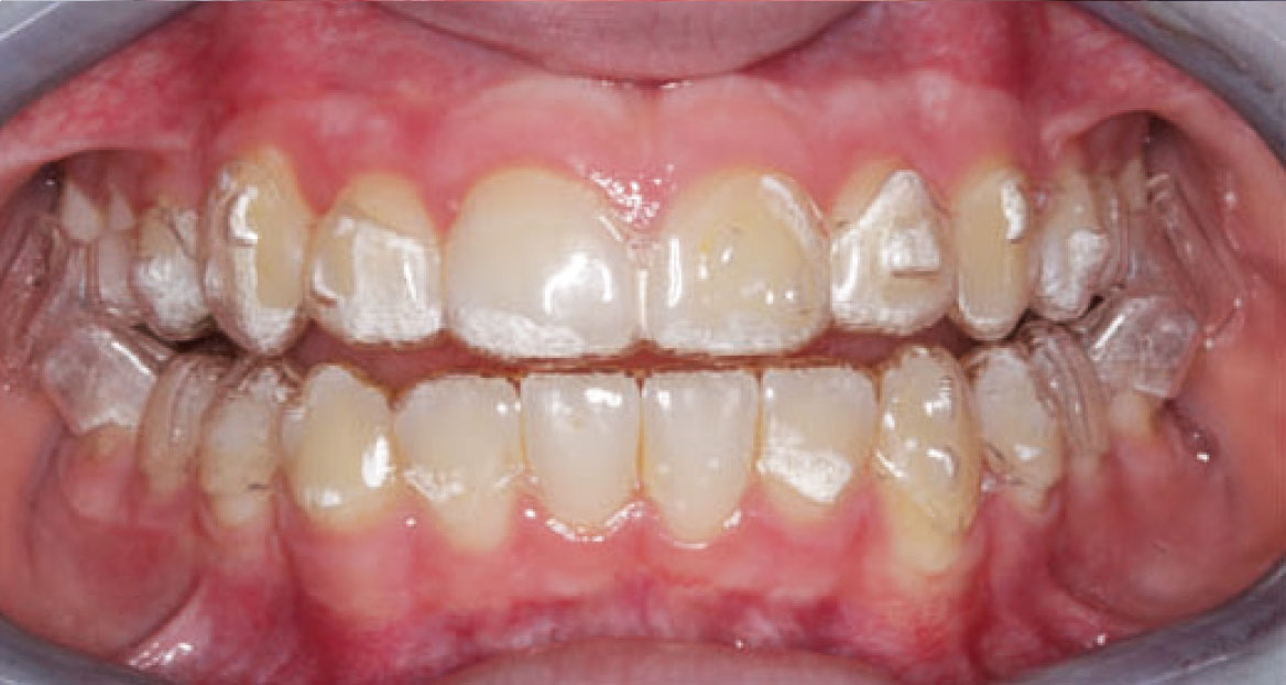 Fig. 7B Foto intraorale frontale, sistema Invisalign® con protocollo MA.