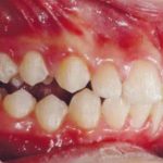 Fig. 15 Fotografia intra orale in fase intermedia di trattamento: laterale destra.