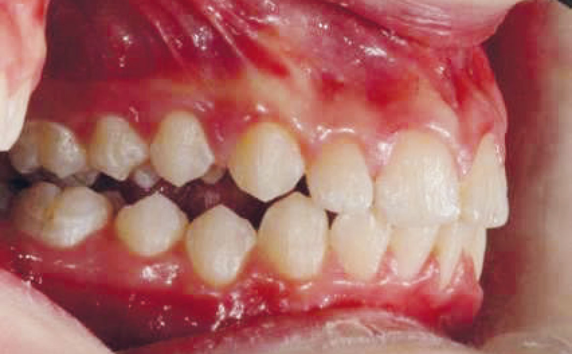 Fig. 15 Fotografia intra orale in fase intermedia di trattamento: laterale destra.