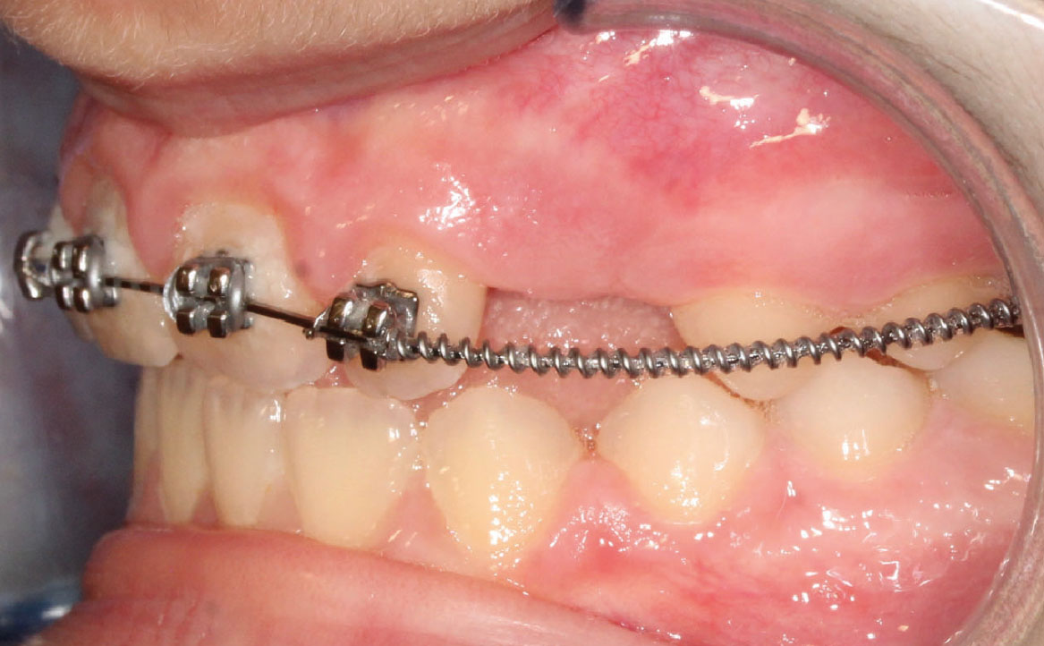 Fig. 8B Terapia intercettiva con REP e bandaggio parziale superiore.