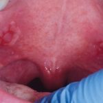 Fig. 5C Caso clinico di pemfigo indotto da farmaci con lesioni erosive diffuse a ventre linguale e palato molle.