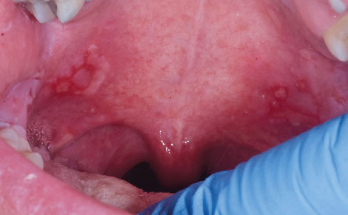 Fig. 5C Caso clinico di pemfigo indotto da farmaci con lesioni erosive diffuse a ventre linguale e palato molle.