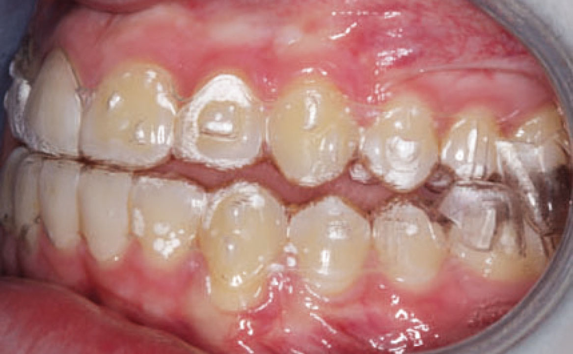 Fig. 7C Foto intraorale laterale di sinistra, sistema Invisalign® con protocollo MA.