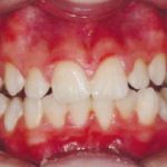 Fig. 16 Fotografia intra orali in fase intermedia di trattamento: frontale.