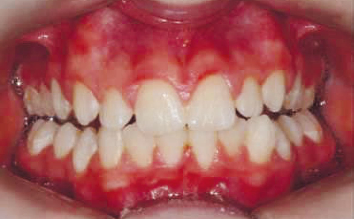 Fig. 16 Fotografia intra orali in fase intermedia di trattamento: frontale.