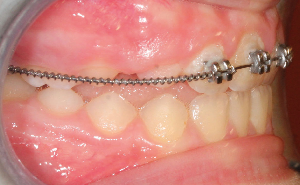 Fig. 8C Terapia intercettiva con REP e bandaggio parziale superiore.