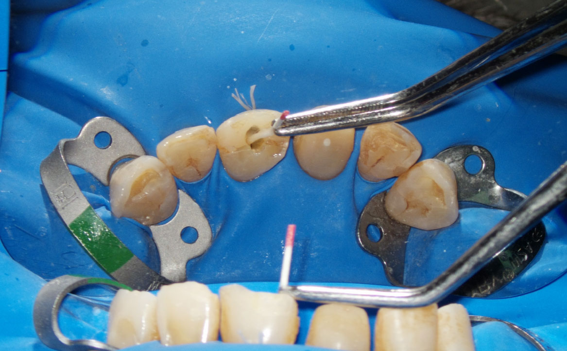 Fig. 8D Terapia canalare di elemento 2.1.: asciugatura del canale.