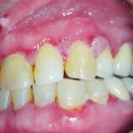 Fig. 6A Caso clinico di lesioni da pemfigoide indotto da farmaci caratterizzate da aeree bollose ed erosive diffuse su mucose geniene e gengive.