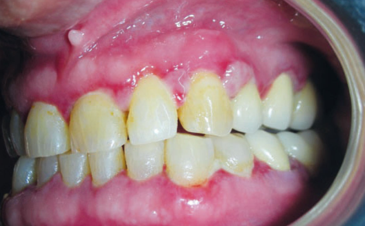 Fig. 6A Caso clinico di lesioni da pemfigoide indotto da farmaci caratterizzate da aeree bollose ed erosive diffuse su mucose geniene e gengive.