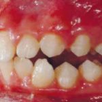 Fig. 17 Fotografia intra orali in fase intermedia di trattamento: laterale sinistra.