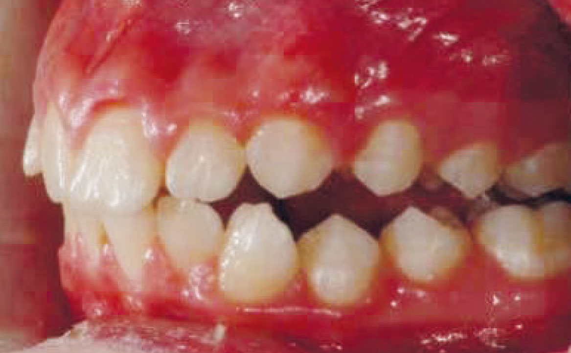 Fig. 17 Fotografia intra orali in fase intermedia di trattamento: laterale sinistra.