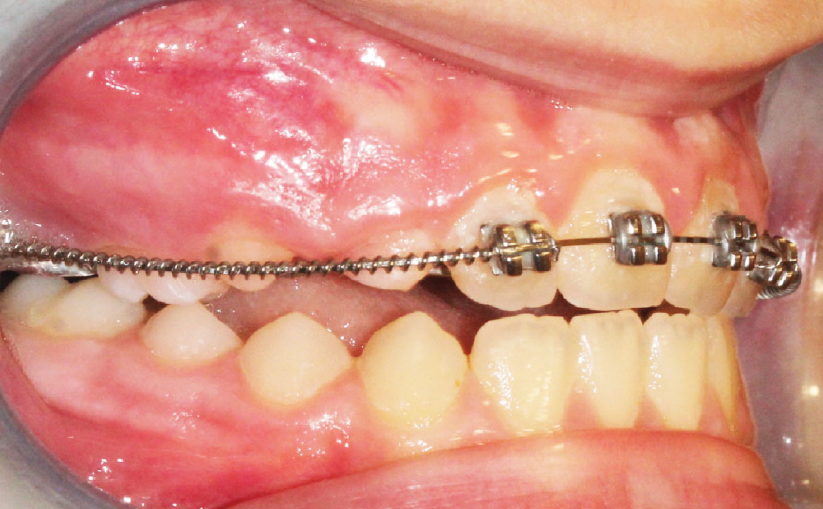 Fig. 8D Terapia intercettiva con REP e bandaggio parziale superiore.