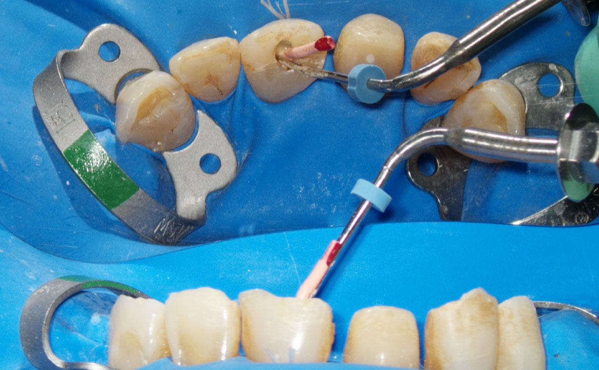 Fig. 8E Terapia canalare di elemento 2.1.: otturazione del canale con onda continua di condensazione.