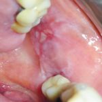 Fig. 6B Caso clinico di lesioni da pemfigoide indotto da farmaci caratterizzate da aeree bollose ed erosive diffuse su mucose geniene e gengive.