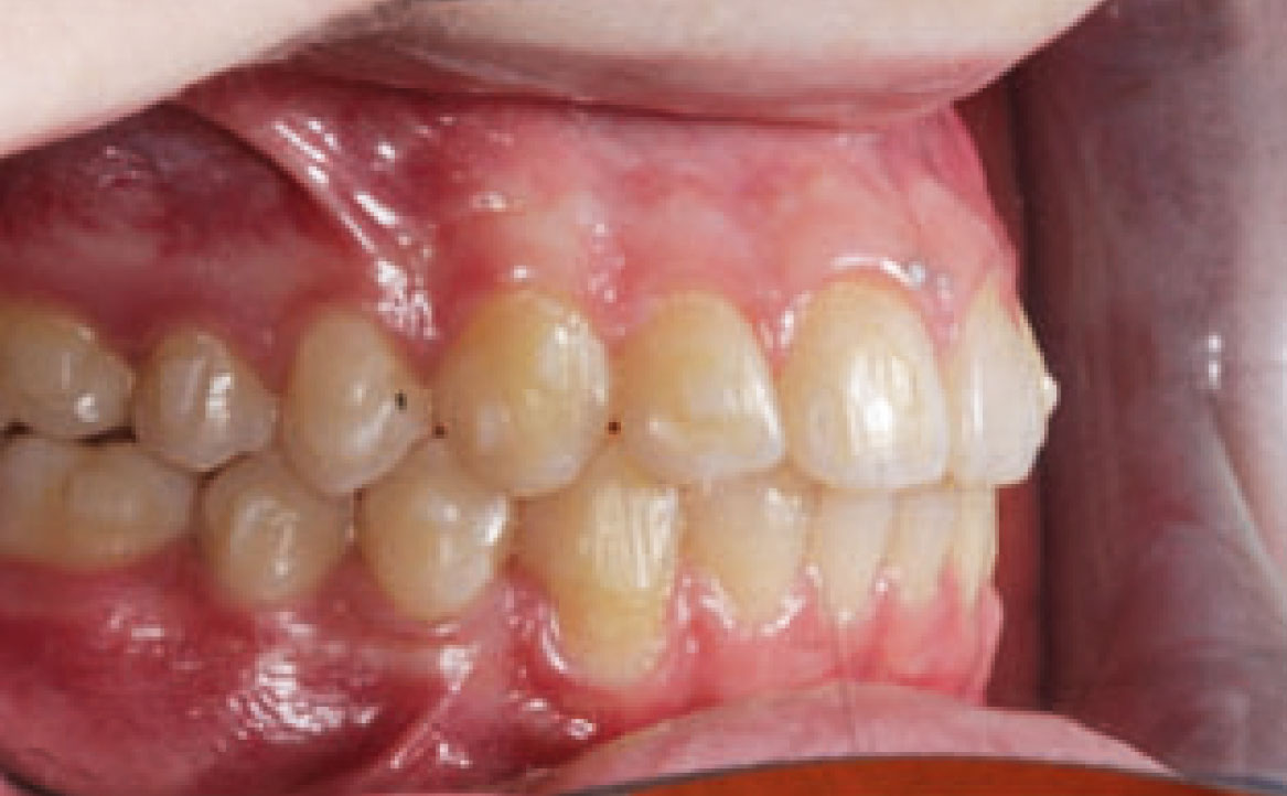 Fig. 9A Foto intraorale finale laterale di destra.