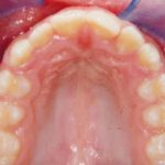 Fig. 18 Fotografia intra orale occlusale in fase intermedia di trattamento.