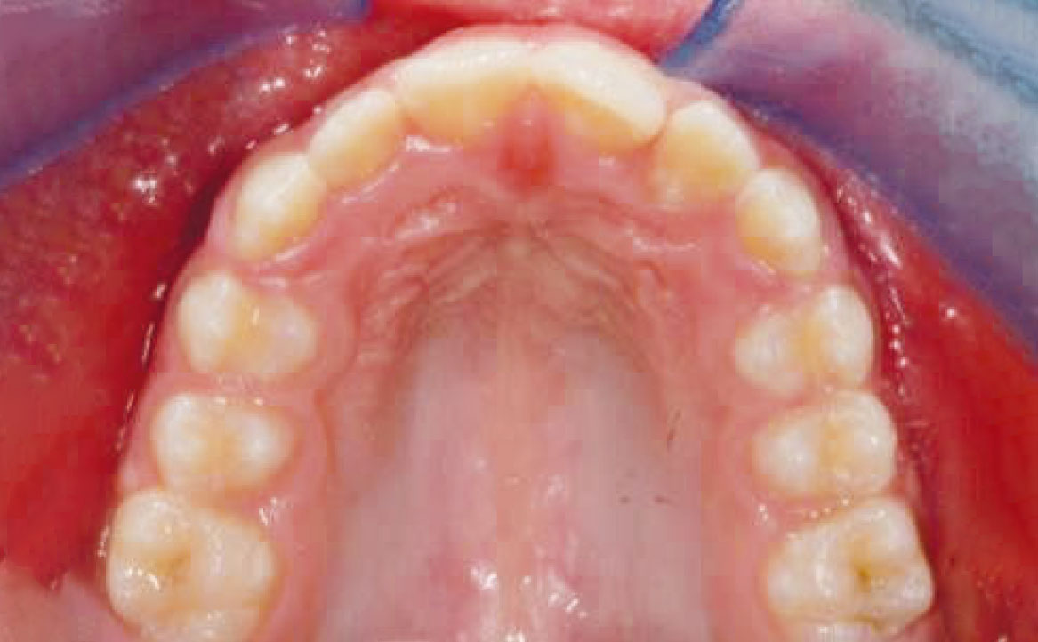Fig. 18 Fotografia intra orale occlusale in fase intermedia di trattamento.