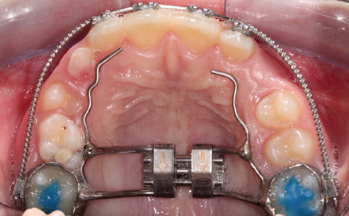 Fig. 8E Terapia intercettiva con REP e bandaggio parziale superiore.