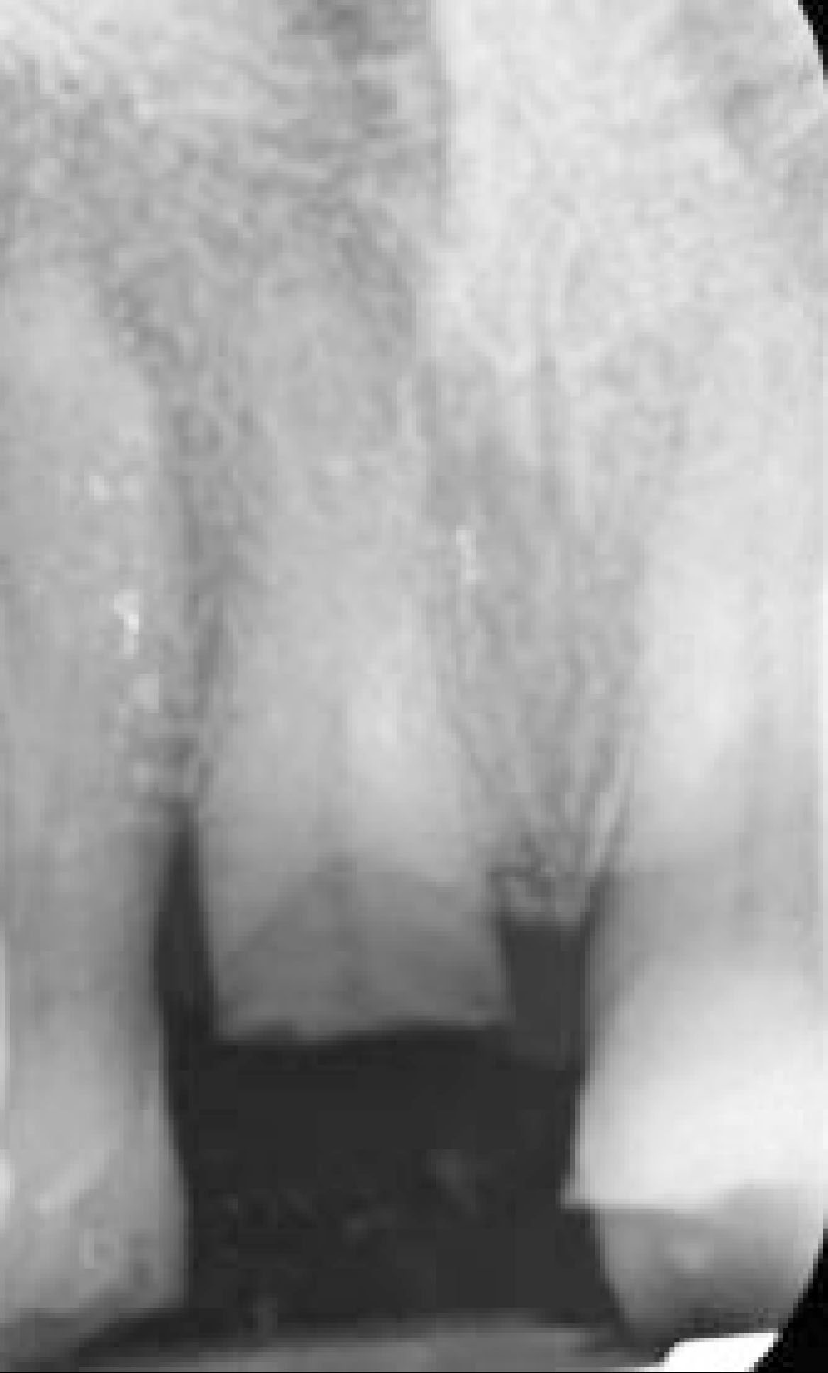 Fig. 8F Terapia canalare di elemento 2.1.: RX iniziale.