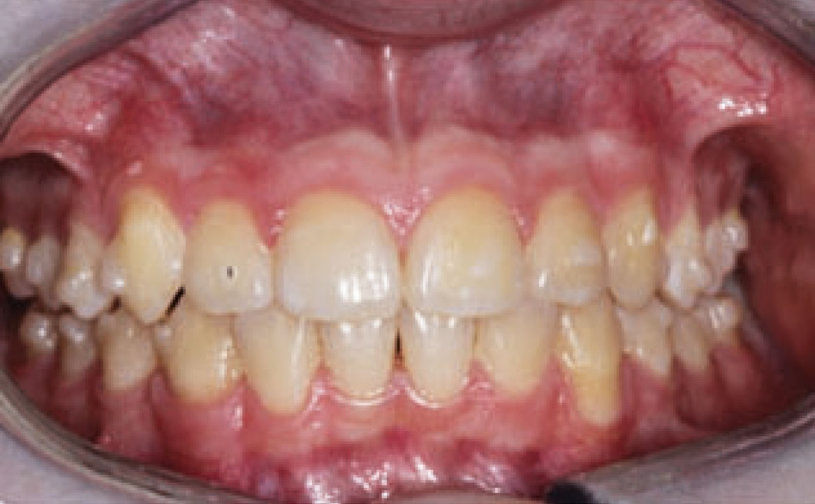 Fig. 9B Foto intraorale finale frontale.