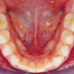 Fig. 19 Fotografia intra orale occlusale in fase intermedia di trattamento.