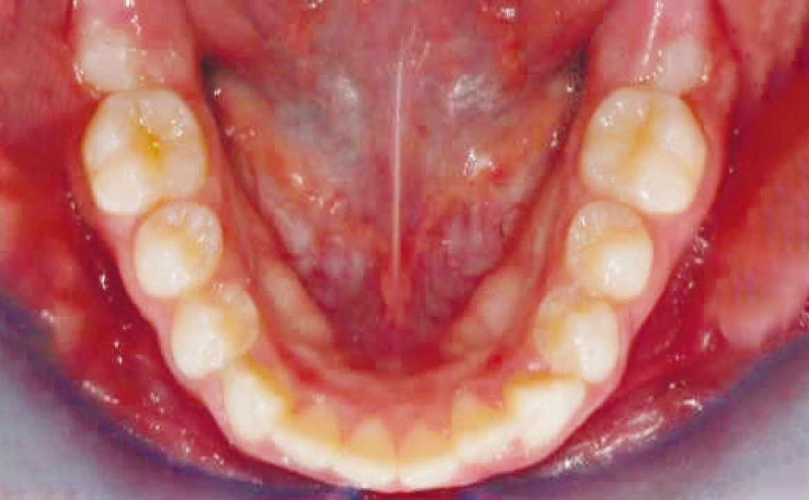 Fig. 19 Fotografia intra orale occlusale in fase intermedia di trattamento.