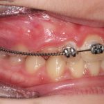 Fig. 9A Dopo 9 mesi dall’inizio del trattamento ortodontico