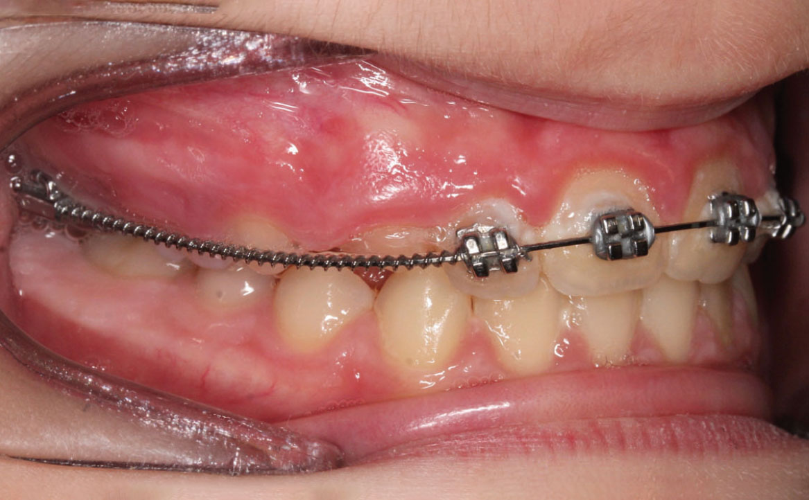 Fig. 9A Dopo 9 mesi dall'inizio del trattamento ortodontico