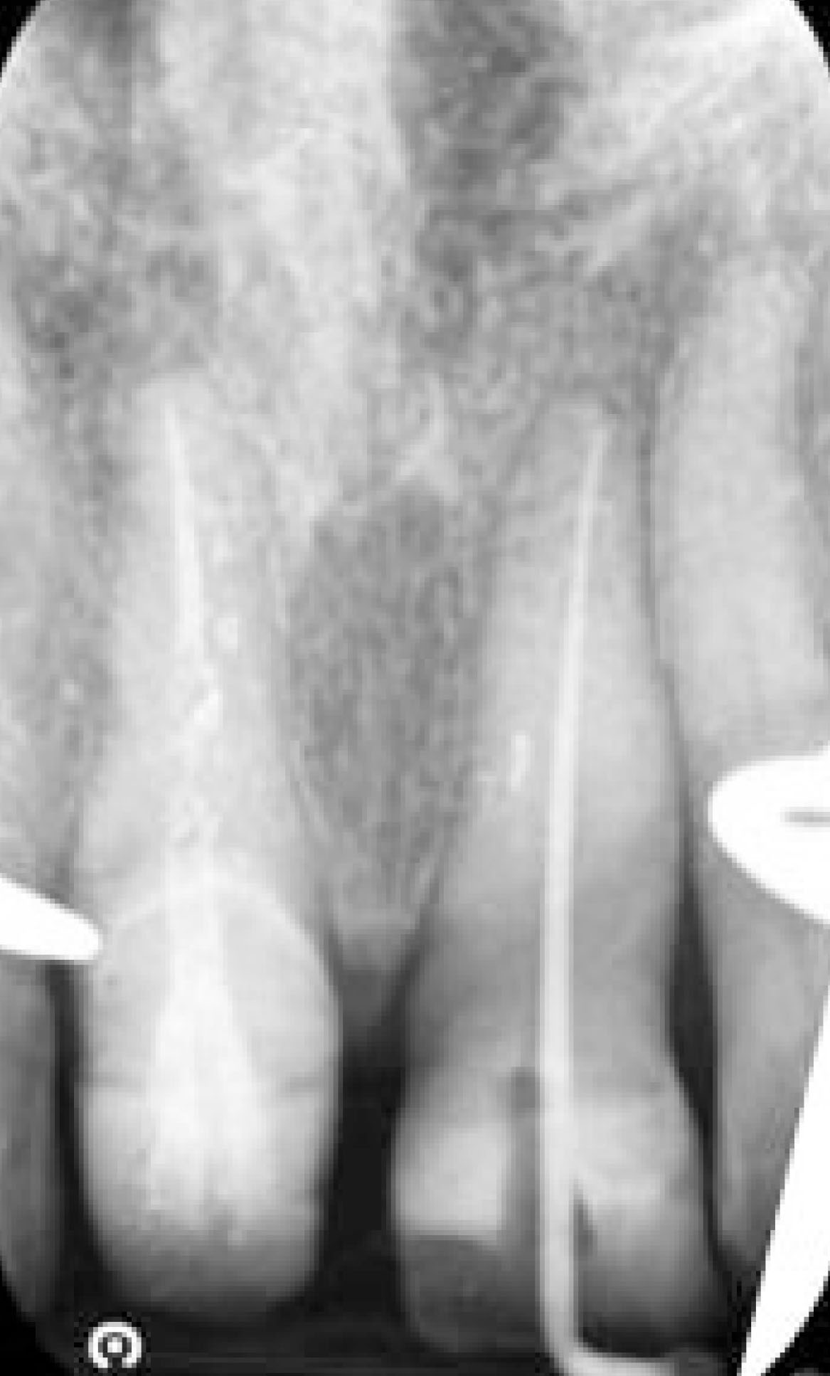 Fig. 8G Terapia canalare di elemento 2.1.: RX intraoperatoria per la verifica della lunghezza di lavoro.