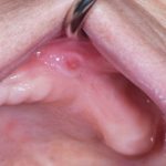 Fig. 7A Caso clinico di paziente che ha sviluppato lesione aftoso-simile a livello della mucosa alveolare in seguito alla assunzione di farmaci antipertenasivi.