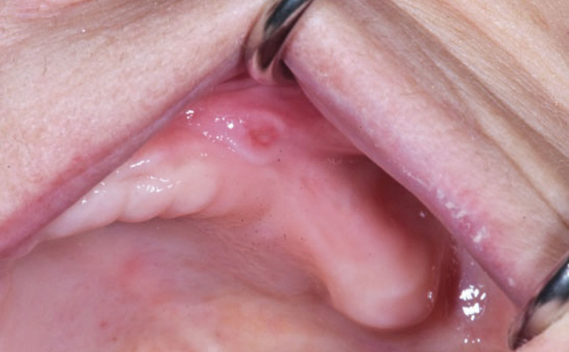 Fig. 7A Caso clinico di paziente che ha sviluppato lesione aftoso-simile a livello della mucosa alveolare in seguito alla assunzione di farmaci antipertenasivi.