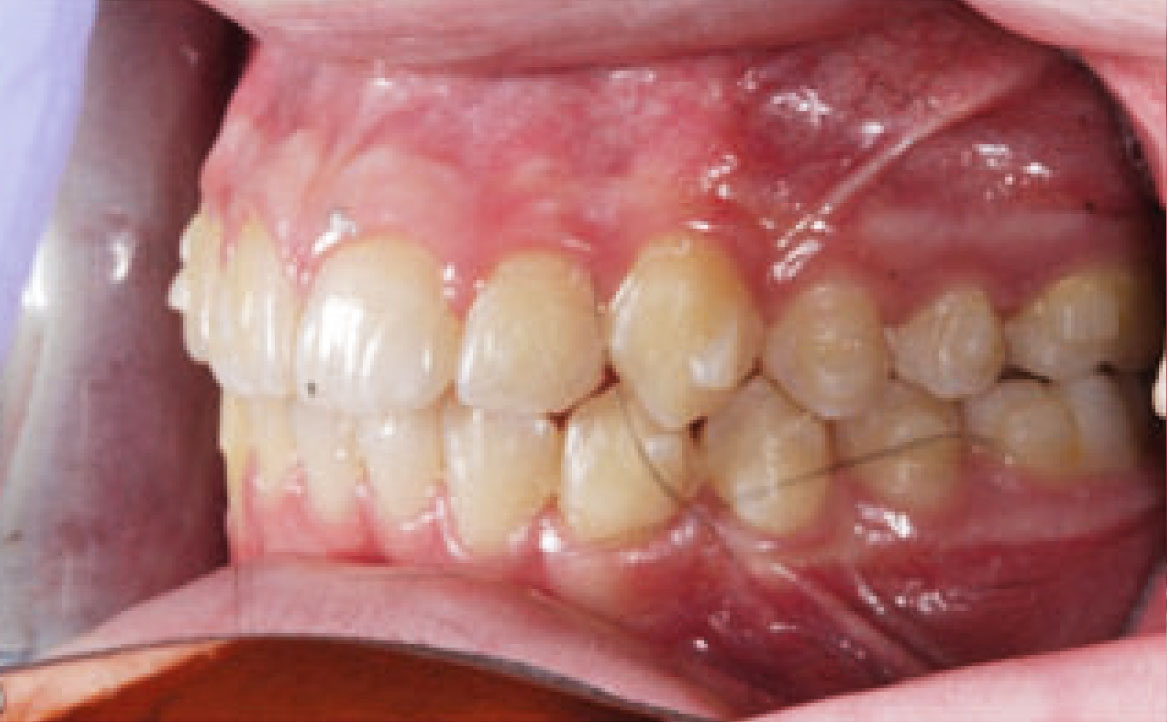 Fig. 9C Foto intraorale finale laterale di sinistra.