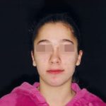 Fig. 20 Fotografia extra orale finale: frontale a riposo.