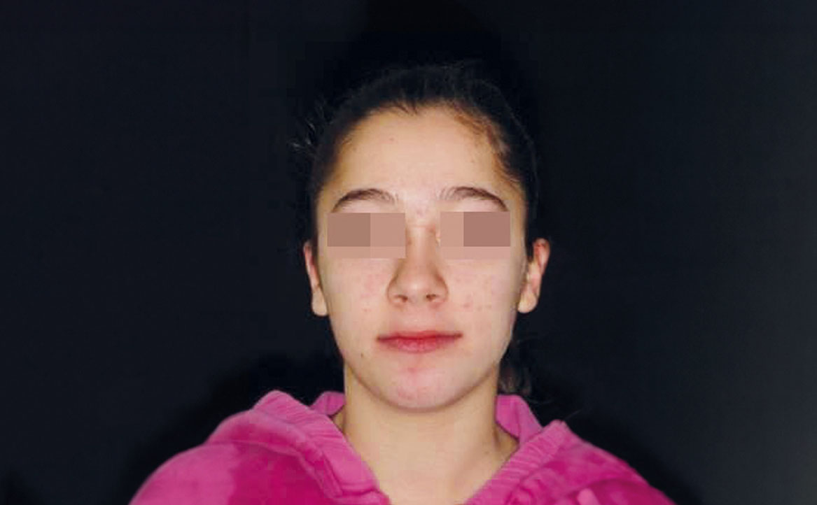 Fig. 20 Fotografia extra orale finale: frontale a riposo.